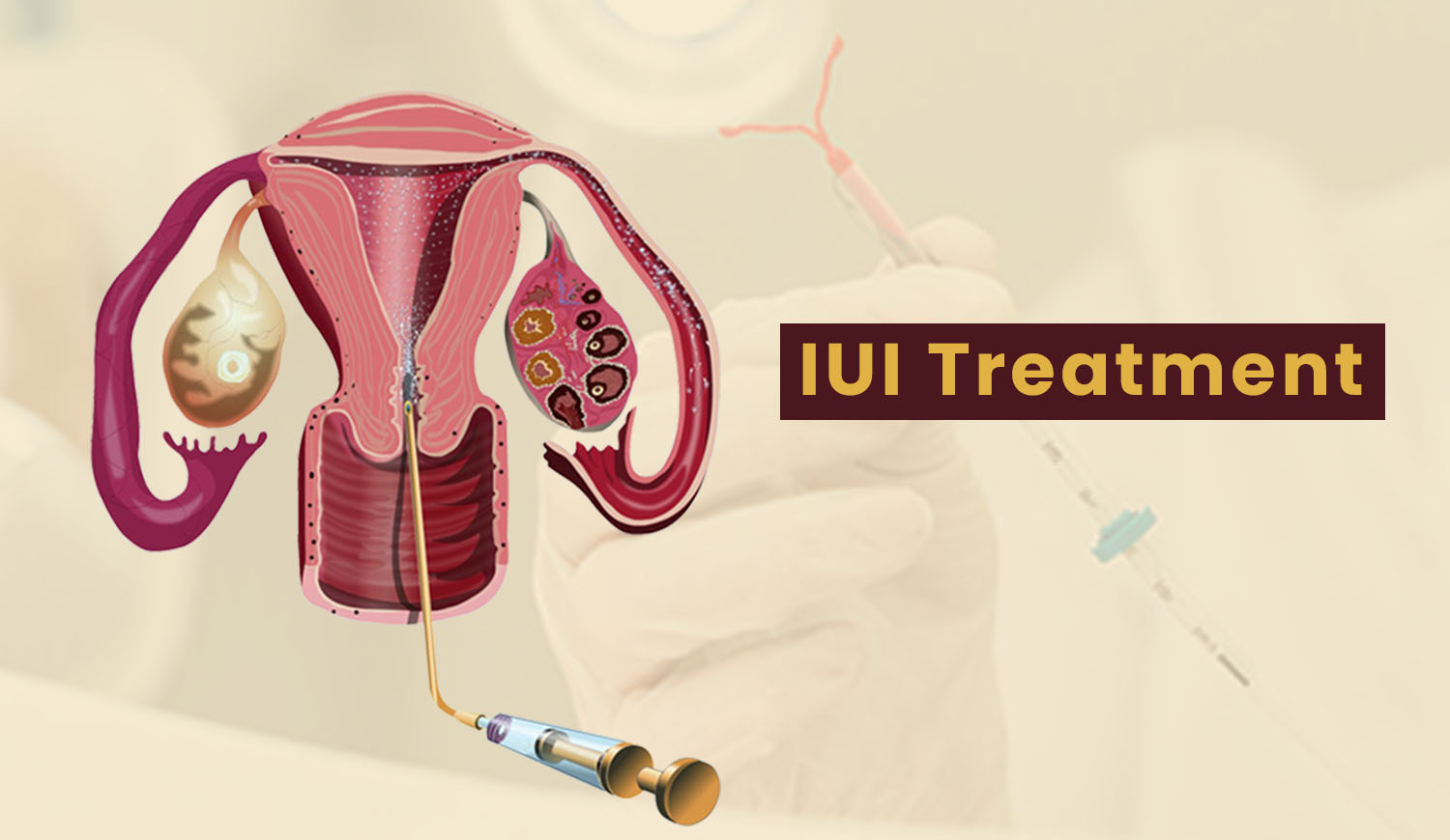 IUI Treatment