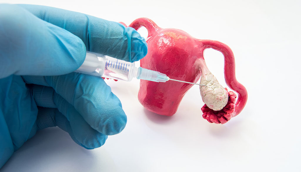 Ovulation Induction